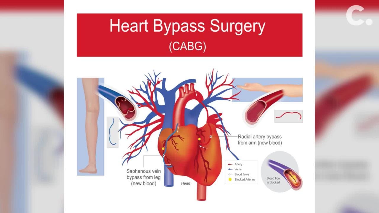 What Is Coronary Artery Bypass Grafting?